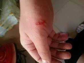 夏季被宠物狗抓伤怎么办？-2.jpeg